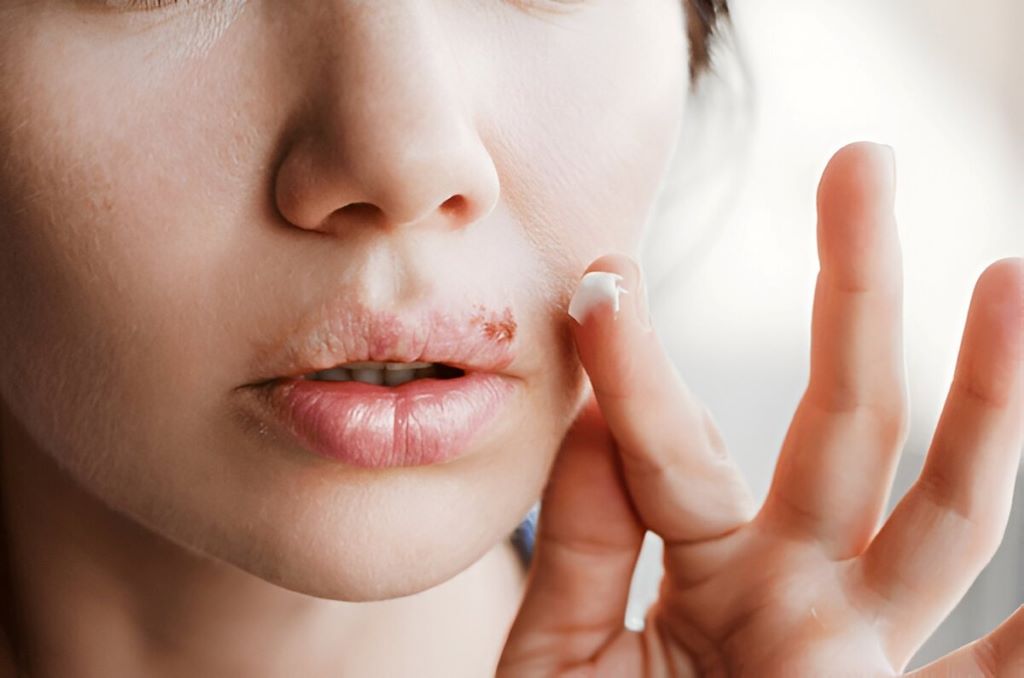 cold sore treatment near you