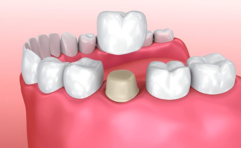 dental crowns near you