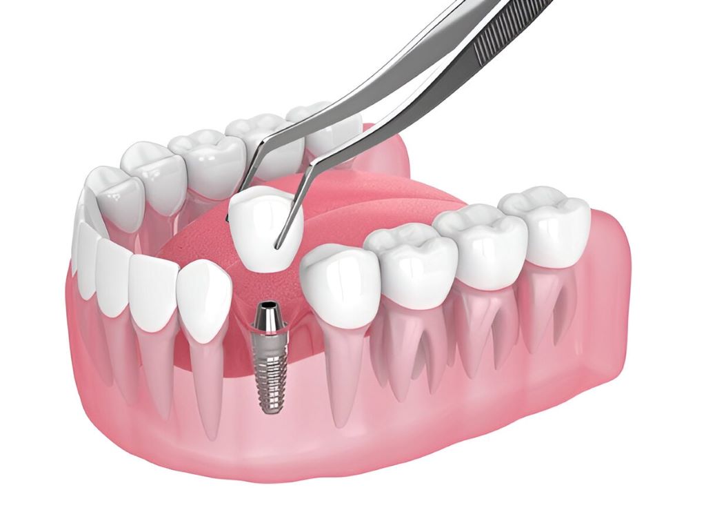 dental implants in bridgeland ab