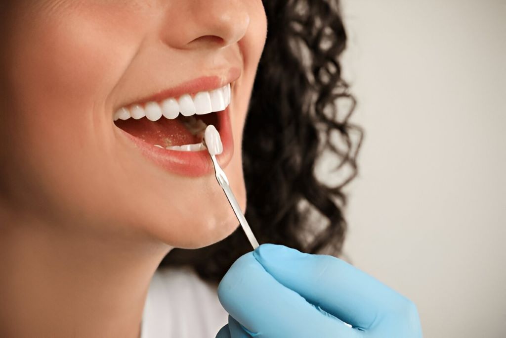 dental veneers near you