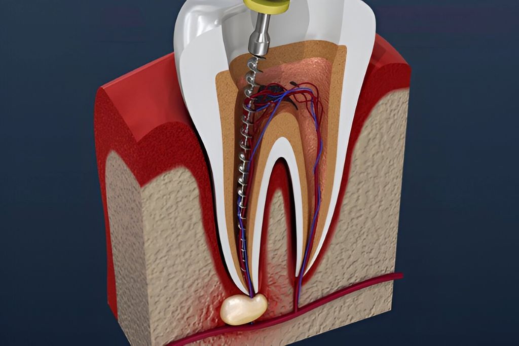 root canals near you