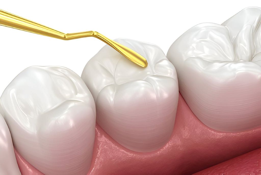 white fillings composite in bridgeland ab