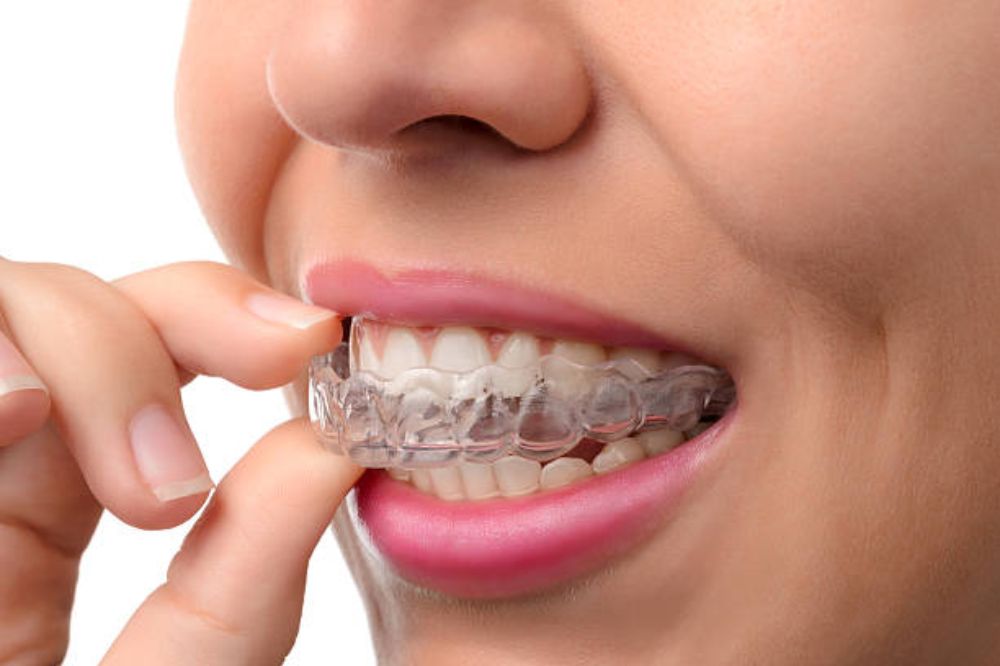 Invisalign in Bridgeland