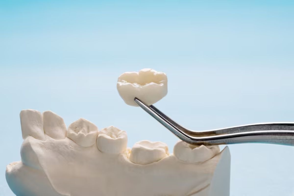 dental crown restoration model