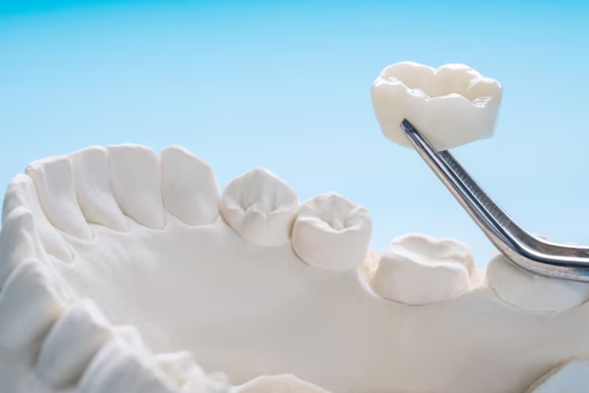dentist demonstrating dental crown placement on a tooth model