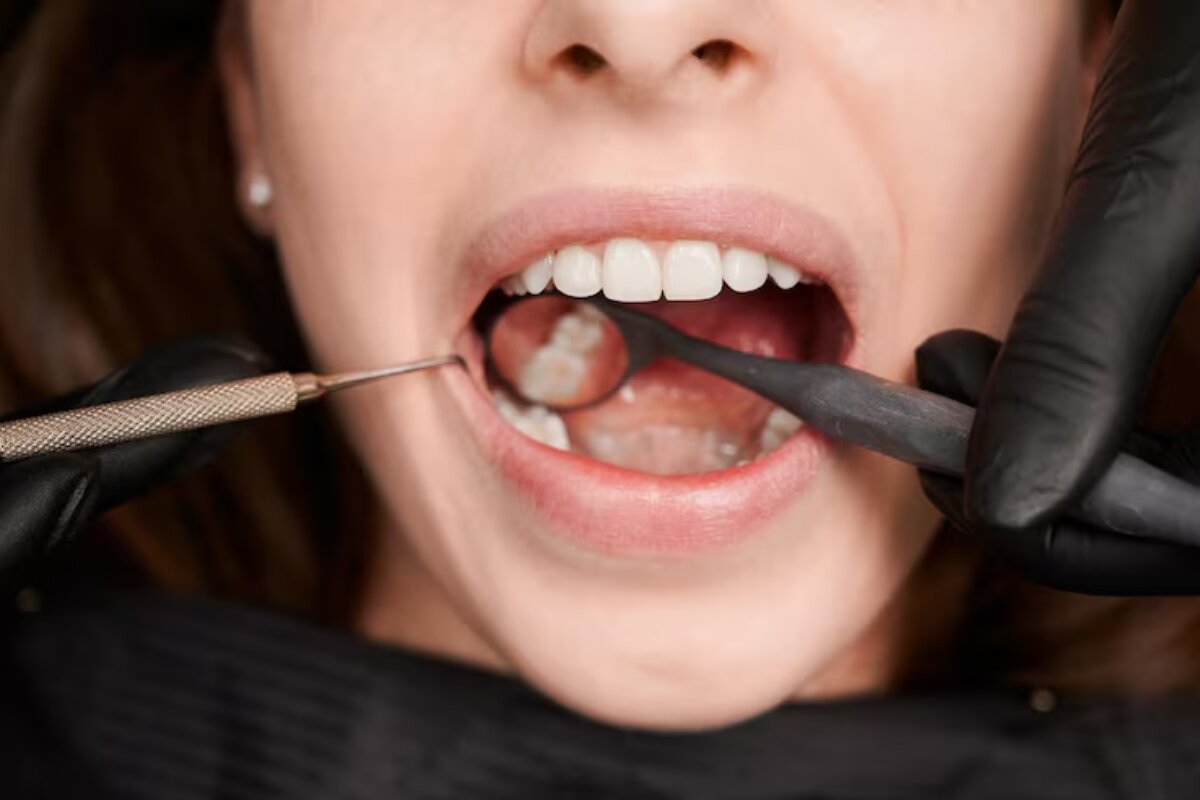 Dentist examining wisdom tooth before extraction